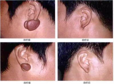 跟瘢痕疙瘩、皮膚血管瘤說(shuō)拜拜--放射性核素敷貼治療